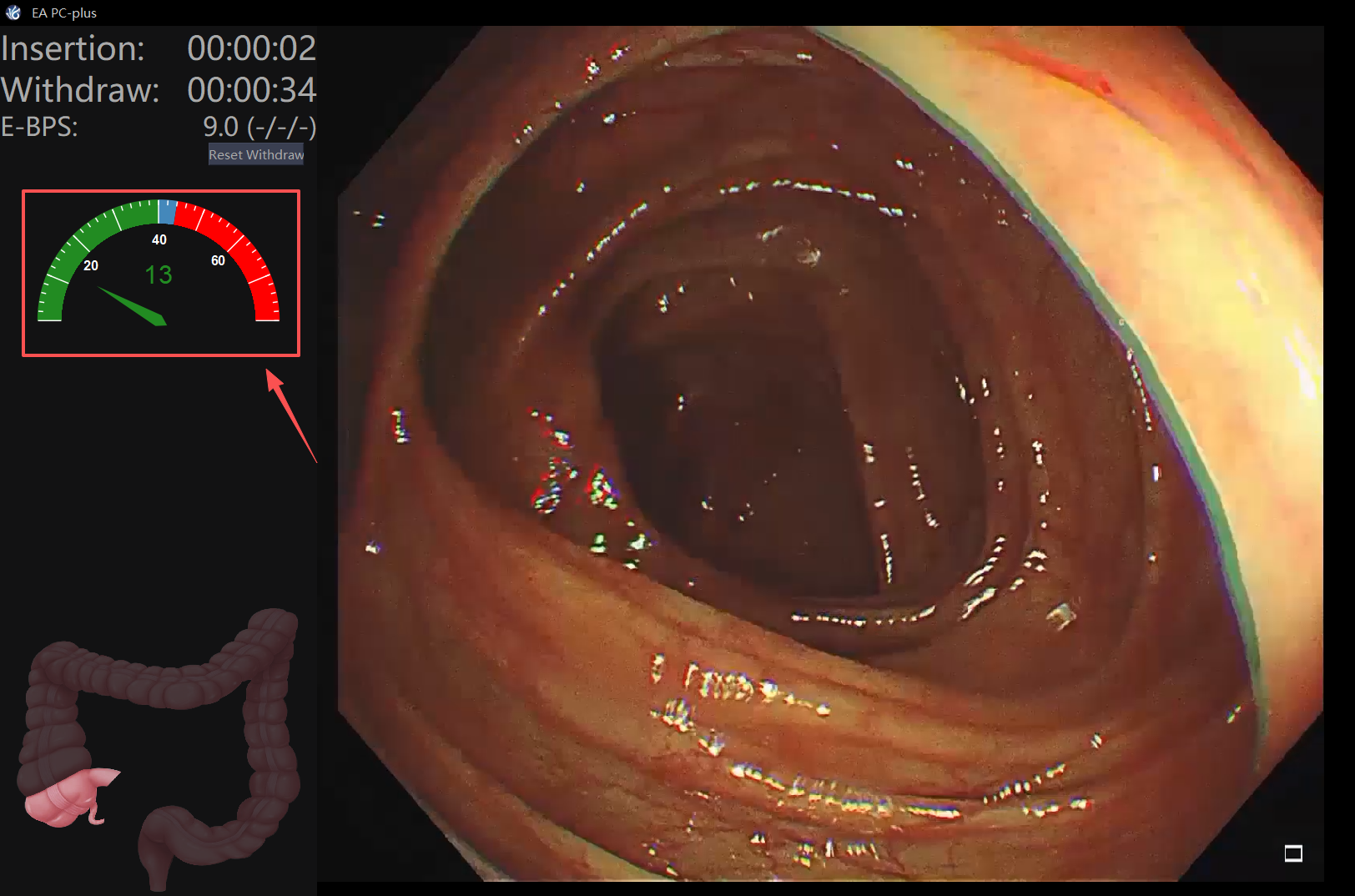 Colonoscopy withdrawal quality control
