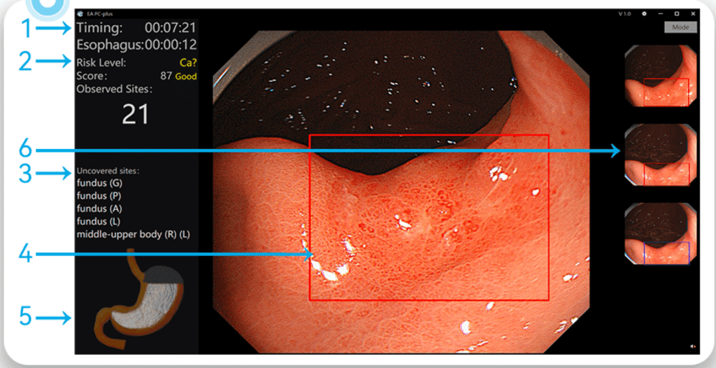 Technology Colonoscopy AI — Detection Interface