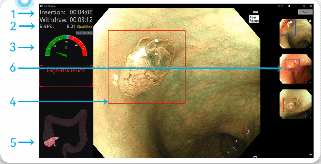 Technology Colonoscopy AI — Withdrawal Interface