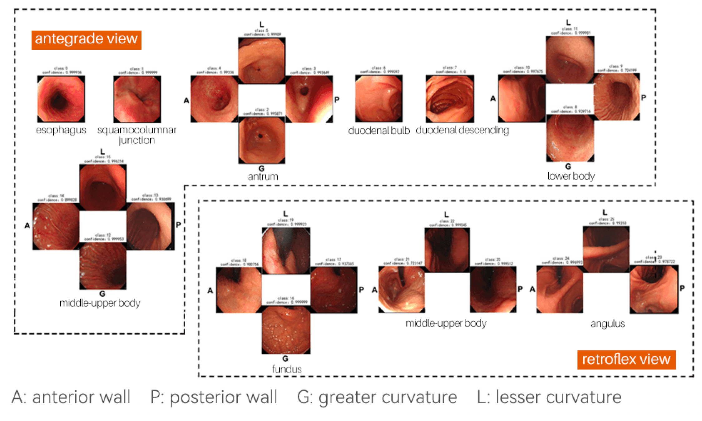 Technology Blind spot monitoring upper GI endoscopy 26 zones