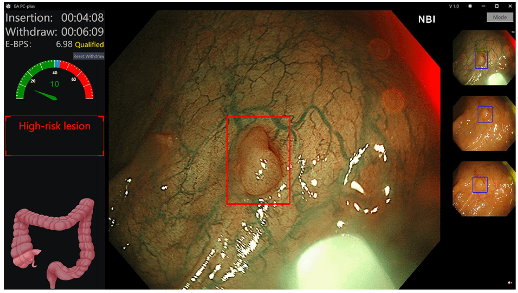 Technology Withdrawal speed monitoring colonoscopy