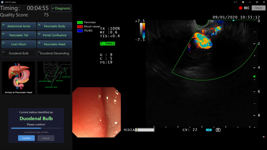 EndoAngel EUS AI pancreas segmentation with precise boundary annotation during endoscopic ultrasound