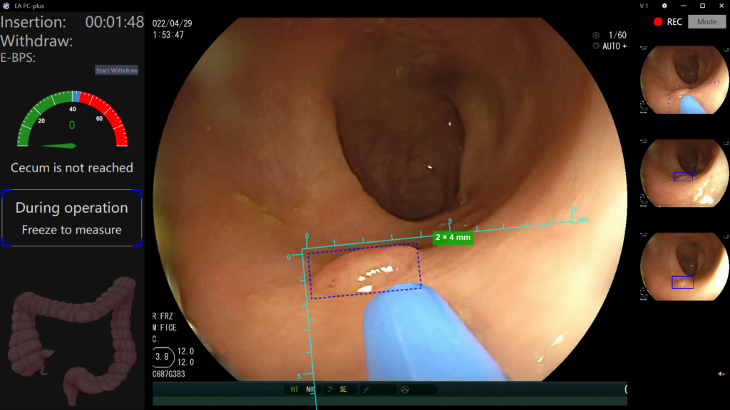EndoAngel AI instrument detection and measurement during endoscopic procedure